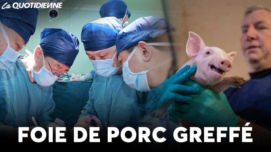 EPISODE 926 : Foie de porc greffé
