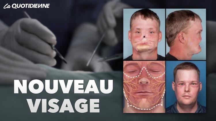 Épisode 355 : Nouveau visage