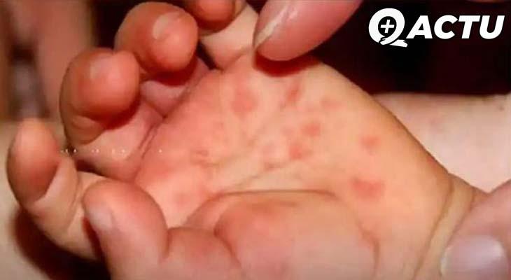 Après la variole du singe, la grippe de la tomate ! (ça existe vraiment)