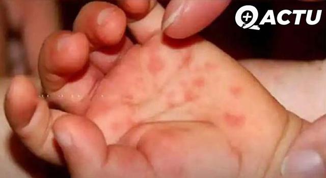 Après la variole du singe, la grippe de la tomate ! (ça existe vraiment)